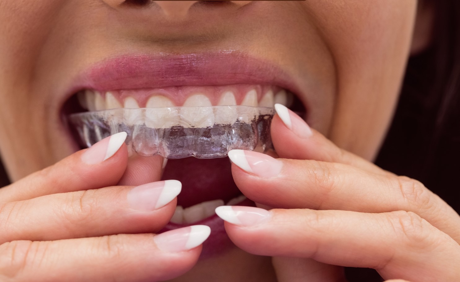 ortodoncia invisible